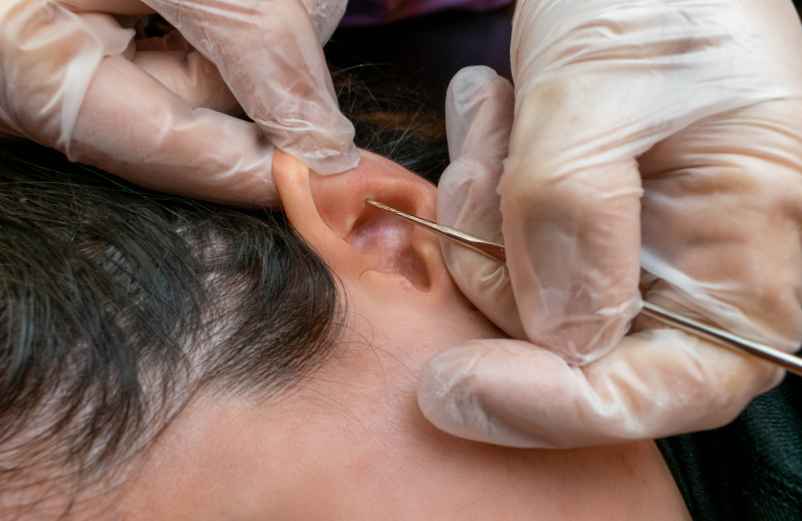 En combien de temps un bouchon d’oreille part-il naturellement ?-France Audition